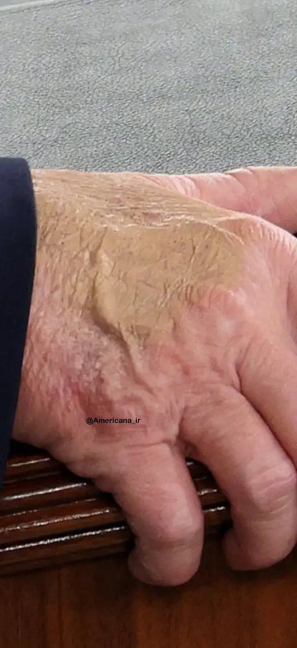 دست ترامپ سوژه شد / آیا وضعیت جسمانی رئیس‌جمهور آمریکا نگران‌کننده است؟