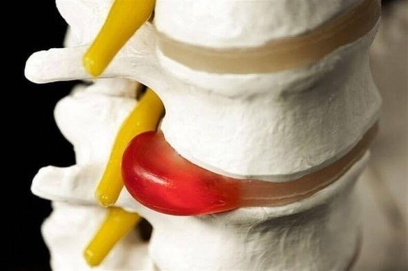 دیسک کمر همیشه به جراحی ختم نمی شود